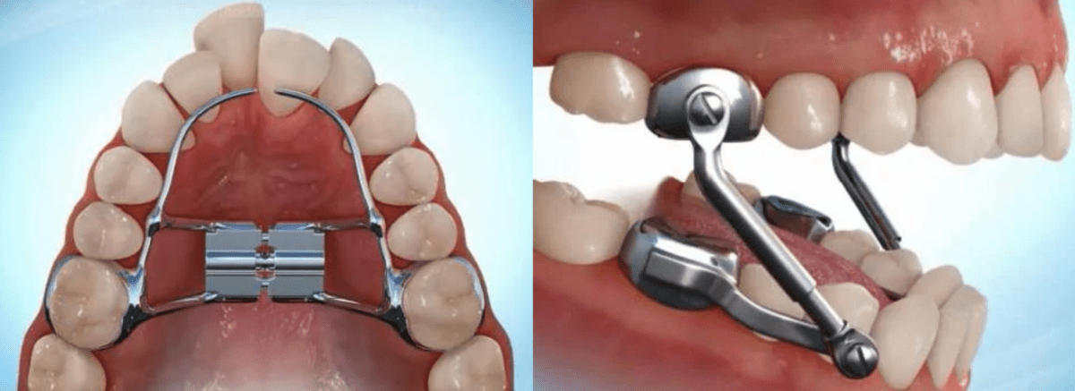 Herbst Appliance Care Orthodontix